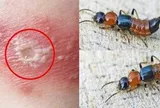 5 bước xử lý đúng cách khi tiếp xúc với kiến 3 khoang