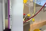 Người phụ nữ ngoài 30 tuổi máu trắng như sữa sau khi uống 4 cốc nước "vạn người mê" trong 1 ngày